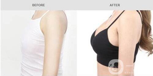 雙平面隆胸的缺點是什么 *果自然嗎