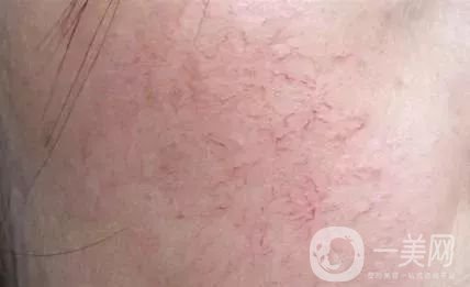 臉上長(zhǎng)紅血絲怎么辦?去紅血絲攻略親測(cè)*