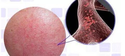 臉上長(zhǎng)紅血絲怎么辦?去紅血絲攻略親測(cè)*