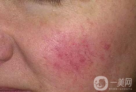 臉上長(zhǎng)紅血絲怎么辦?去紅血絲攻略親測(cè)*