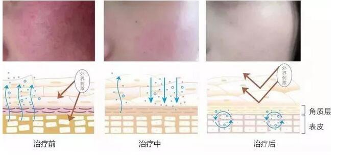 臉上長(zhǎng)紅血絲怎么辦?去紅血絲攻略親測(cè)*
