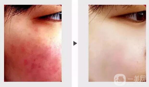 臉上長(zhǎng)紅血絲怎么辦?去紅血絲攻略親測(cè)*