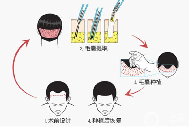 植發(fā)的*果是*性的嗎 它的原理是什么？