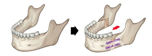 雙頜前突是什么 凸嘴不好看該怎么辦？
