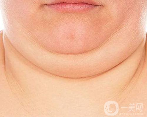 雙下巴怎么形成的 如何去掉雙下巴? 