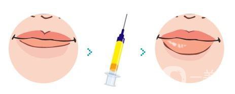 玻尿酸豐唇用小分子嗎 玻尿酸的作用有哪些