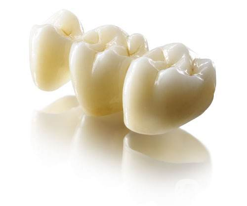 烤瓷牙多少錢一顆 烤瓷牙的種類有哪些