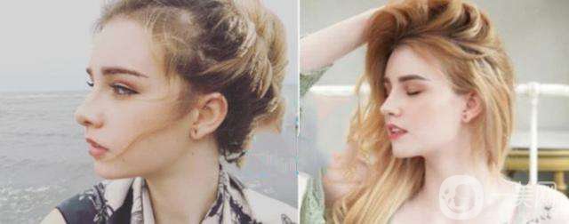 做下巴好不好 做下巴整形手術的方法