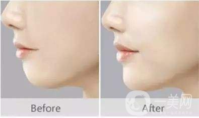做下巴好不好 做下巴整形手術的方法