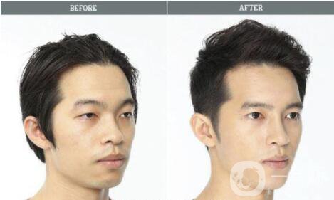 男性整容手術(shù)有哪些項(xiàng)目 男性整容好不好