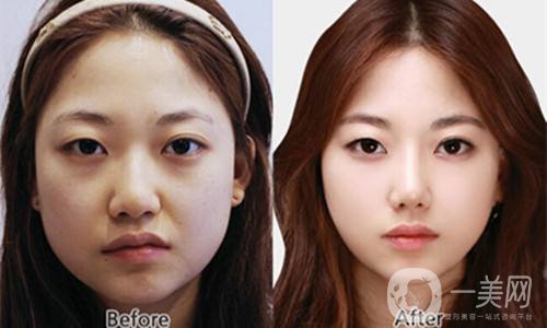 三個(gè)驚人的小竅門 可以使整形手術(shù)恢復(fù)得更快