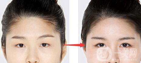 開眼角的風(fēng)險(xiǎn)大嗎 開眼角*果好不好