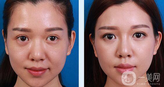 埋線面部提升多久恢復 術(shù)后如何護理？