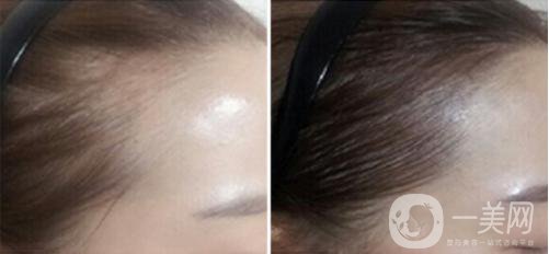 發(fā)際線做了能保持多久時間 發(fā)際線有危害嗎