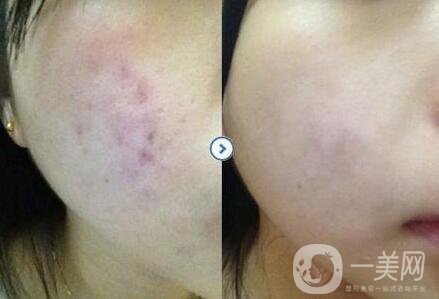 激光祛痘印的費(fèi)用,激光祛痘印術(shù)后護(hù)理