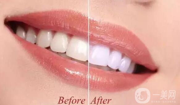 牙齒美白小竅門
