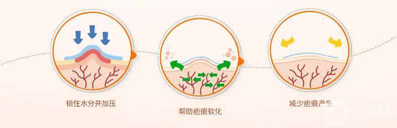 祛疤手術好還是激光好 恢復時間分別是多久