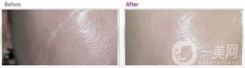 祛疤手術好還是激光好 恢復時間分別是多久