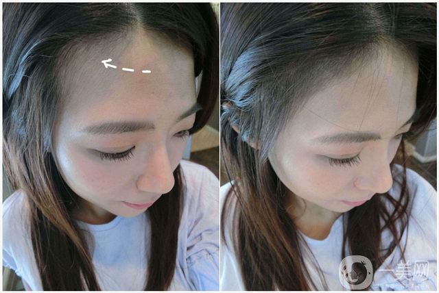 種發(fā)際線*果圖 種發(fā)際線*果*嗎