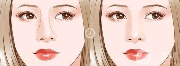 歪鼻矯正需要多少錢 歪鼻矯正的手術(shù)方式