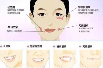 酒窩整形價(jià)格,酒窩整形多久恢復(fù)