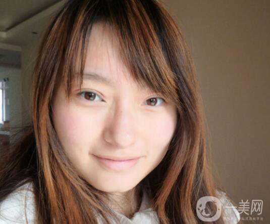 上海九院張波醫(yī)生好不好？醫(yī)生雙眼皮案例附照片