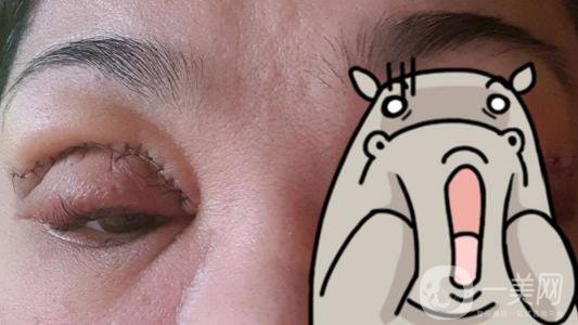 上海九院張波醫(yī)生好不好？醫(yī)生雙眼皮案例附照片