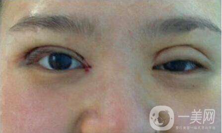 上海九院張波醫(yī)生好不好？醫(yī)生雙眼皮案例附照片