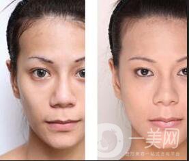 上海玻尿酸豐眉弓,價格貴不貴