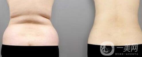 吸脂減肥醫(yī)院如何選擇,吸脂減肥醫(yī)院選擇方法