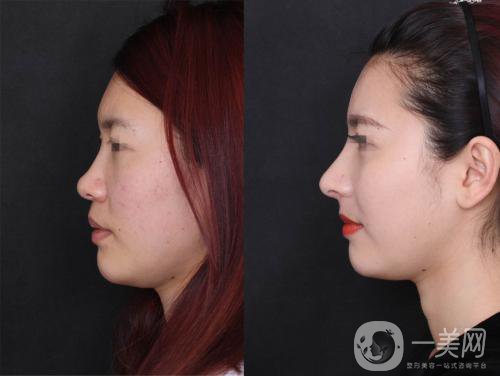 注射隆鼻價(jià)錢(qián)一般是多少?