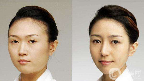 開眼角*果*嗎？開眼角前后照片