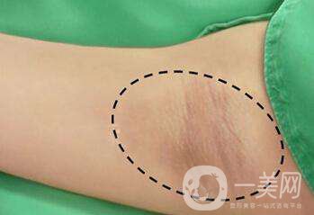 腋臭手術(shù)多久恢復(fù) 術(shù)后何如護理