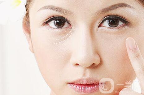 淚溝填充消腫時間