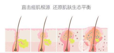 紅藍光祛痘印多少錢 紅藍光祛痘印貴嗎