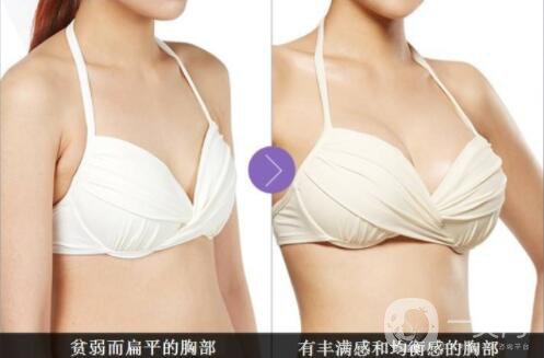 自體脂肪隆胸多久不疼？ 脂肪隆胸的害處？