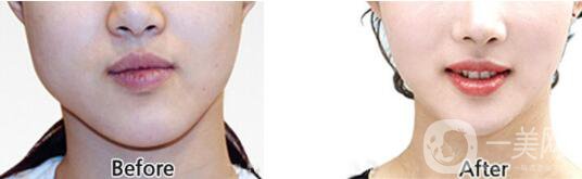 什么是* *手術的特點有哪些