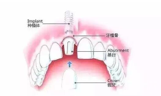 人工種植牙價(jià)格,人工種植牙壽命是多少年