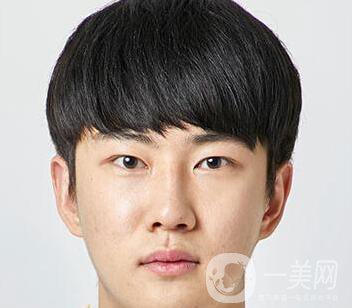 男人隆鼻前后附照片 隆鼻*果好嗎？