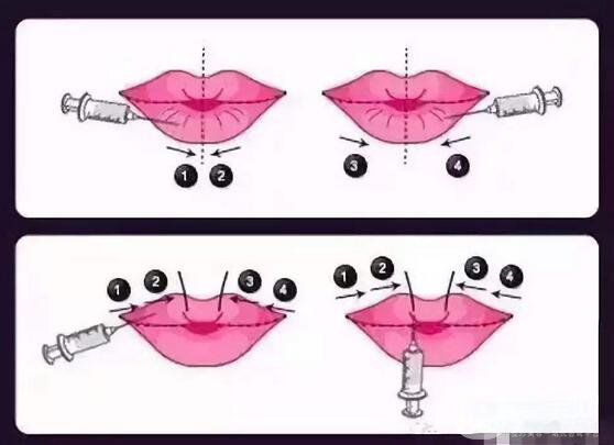 玻尿酸豐唇有什么危害呢 玻尿酸豐唇怎么樣？