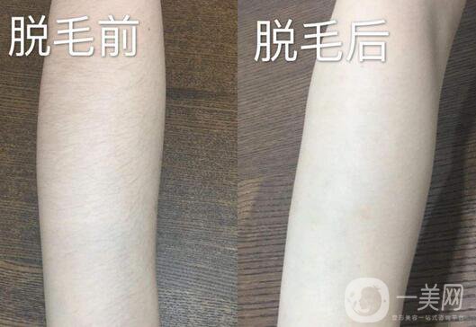 激光脫毛詳細(xì)介紹 激光脫毛有哪些優(yōu)缺點(diǎn)？