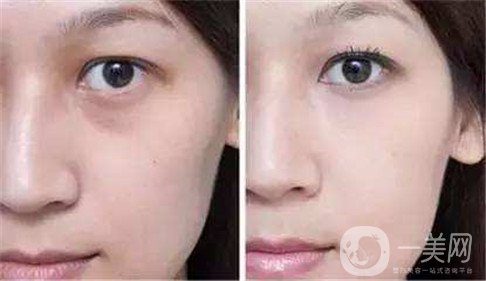 去眼袋手術費用是多少錢 *果*嗎