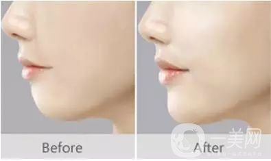 自體脂肪填下巴*果如何? 價(jià)格是多少呢？