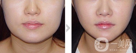 做個(gè)全臉面部抽脂多少錢