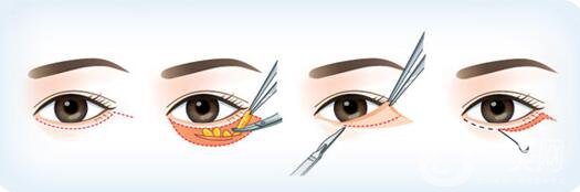 韓式去眼袋怎么樣？多久*果