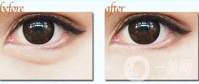 不開刀去處眼袋