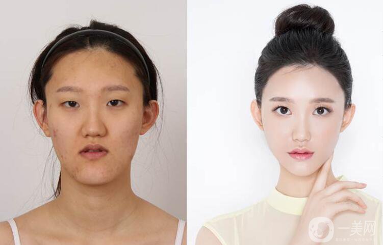 什么是納米雙頜截骨術(shù) 納米雙頜截骨術(shù)的特點(diǎn)