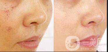 彩光嫩膚*果,彩光嫩膚優(yōu)點,彩光嫩膚副作用