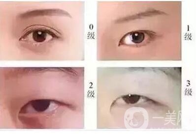 開內(nèi)外眼角的區(qū)別,開內(nèi)眼角,開外眼角