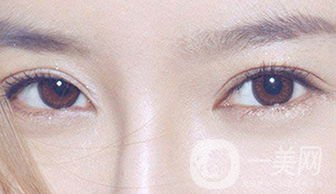 怎么開眼角 開眼角有什么危害嗎？